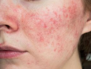 Hidradenitis Suppurativa Skin Care Tips That Can Help Flare-Ups